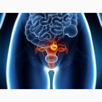 Лечение рака эндометрия (рака тела матки). Лечение в Китае